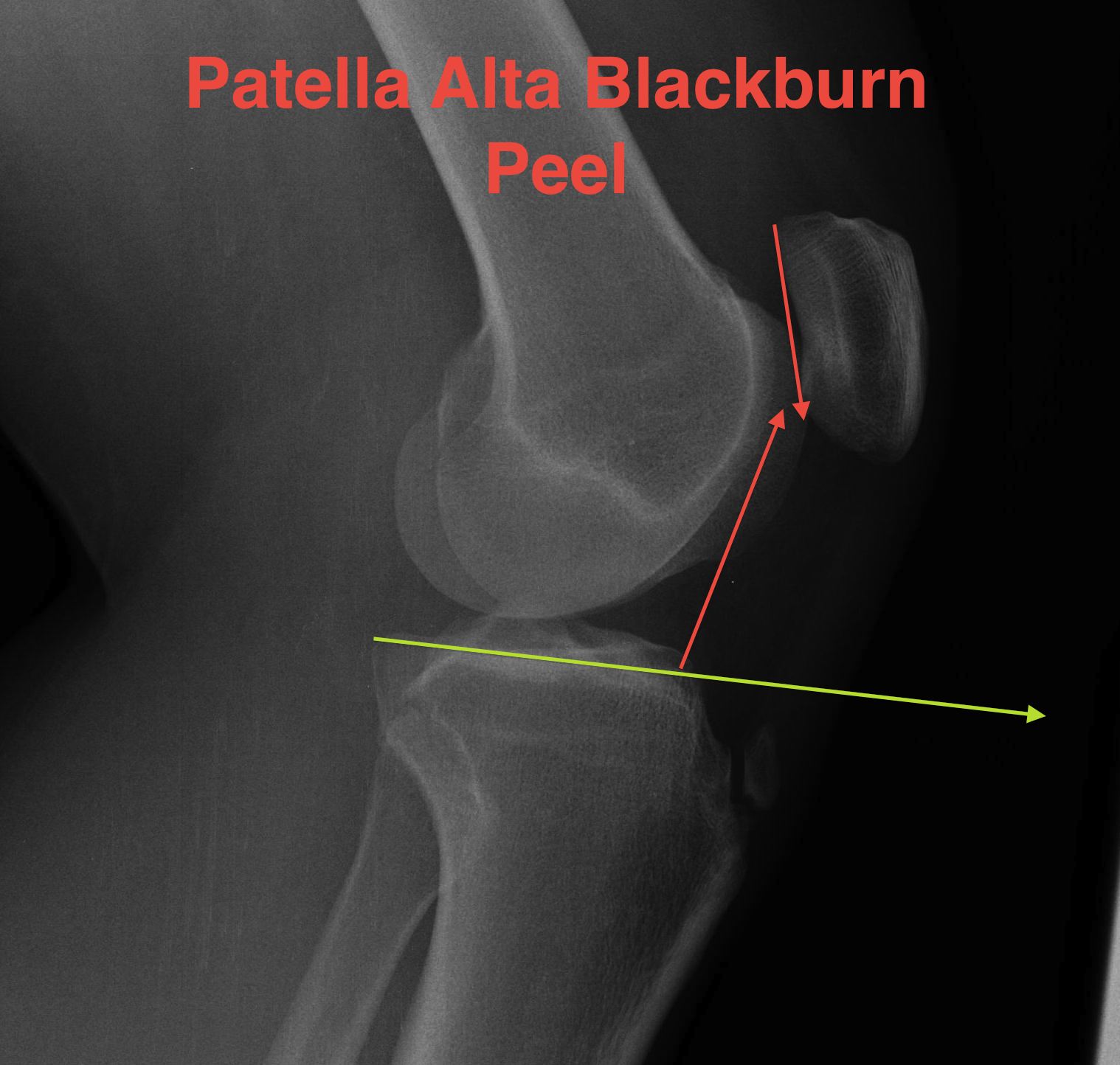 Patella Alta Blackburn Peele